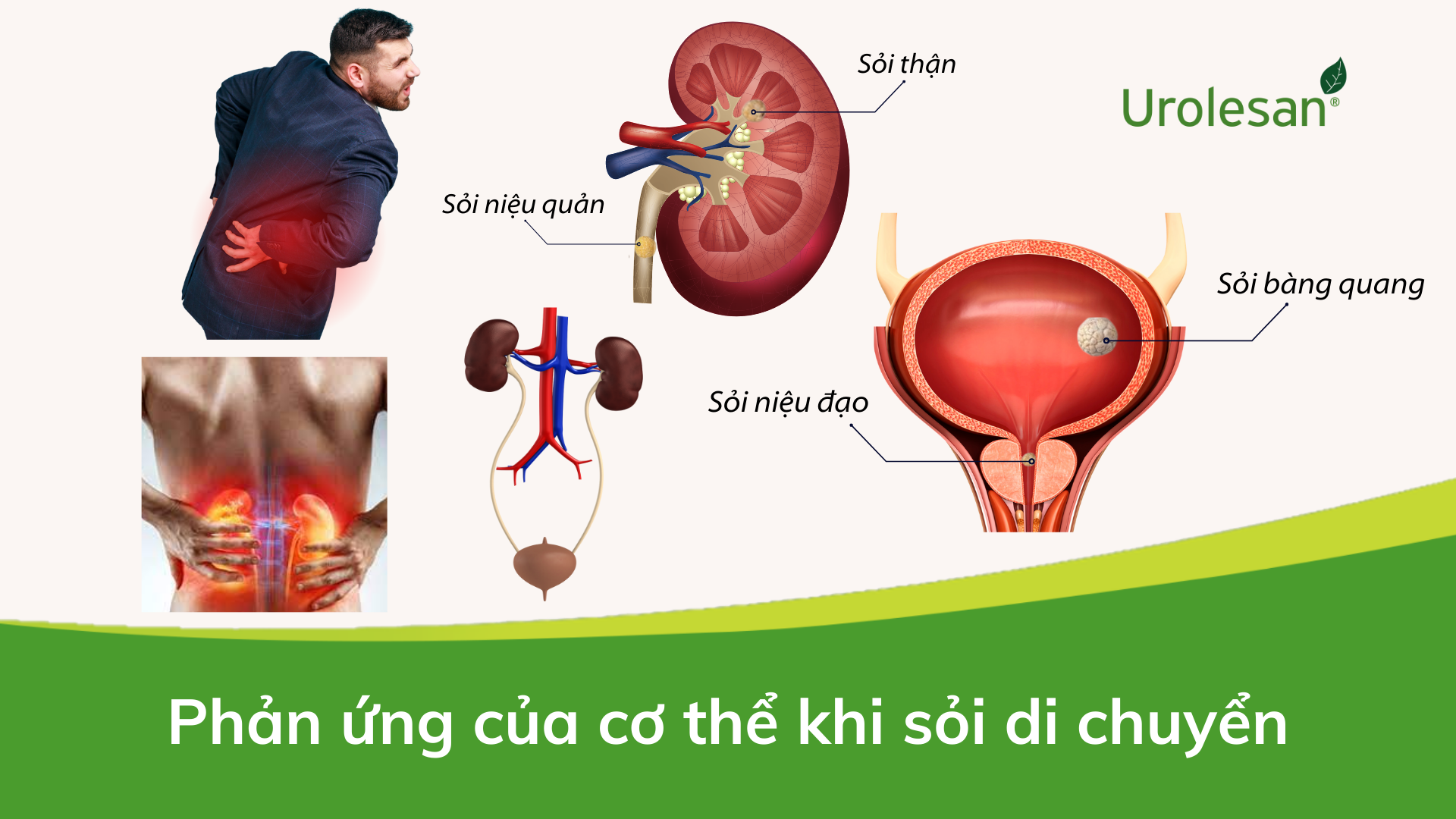 Biểu hiện của cơ thể khi sỏi di chuyển