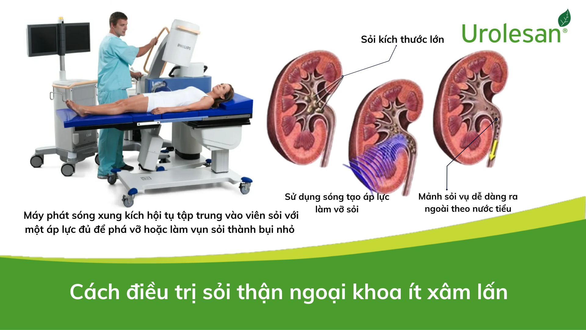 Dứt điểm sỏi niệu ít xâm lấn