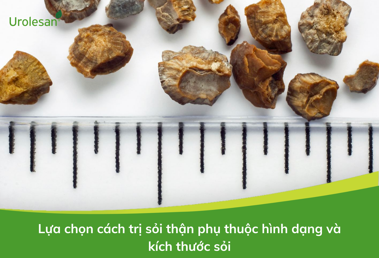 Kích thước và hình dạng sỏi